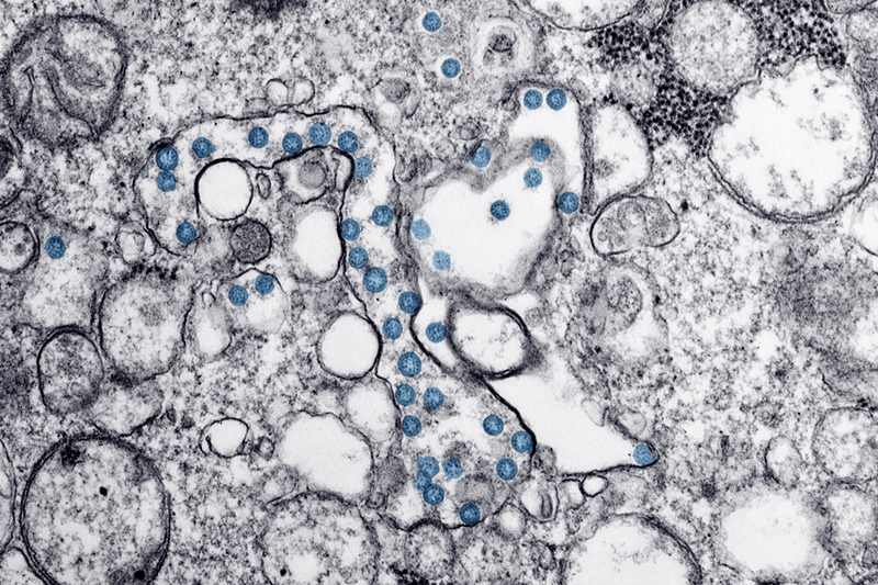 The first confirmed U.S. case of COVID-19 seen through a microscope - Centers for Disease Control and Prevention